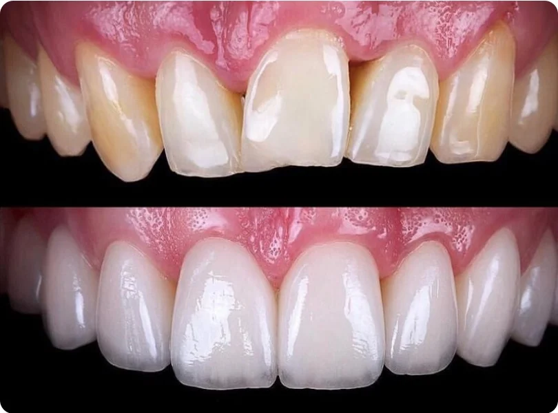 Before and after results of dental veneers