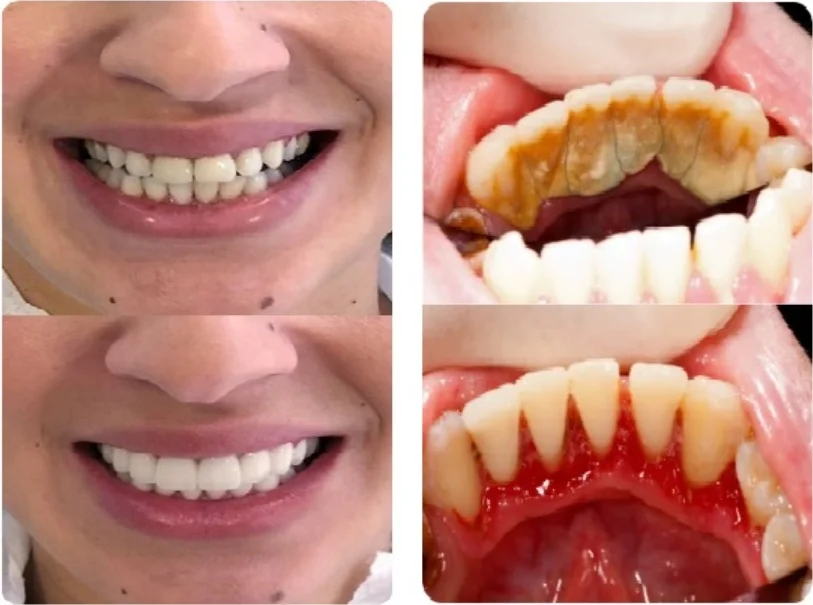 Girl smiling and showing before and after treatment results and before and after teeth cleaning results