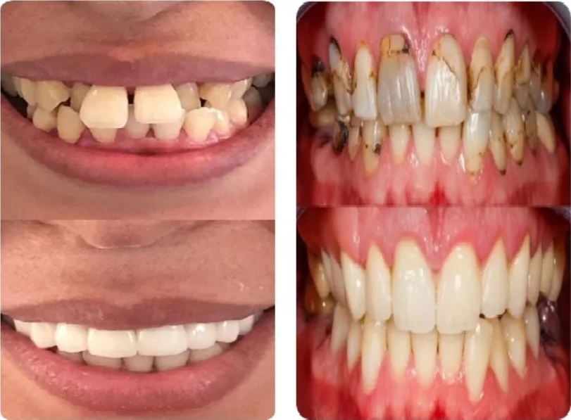 Girl smiling and showing before and after dental treatment results